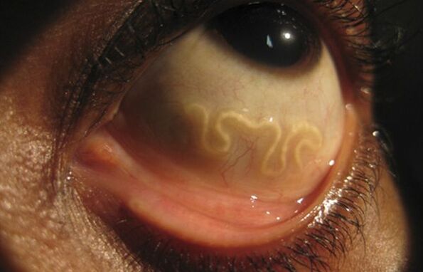 Črv Loa Loa živi v človeškem očesu in povzroča slepoto